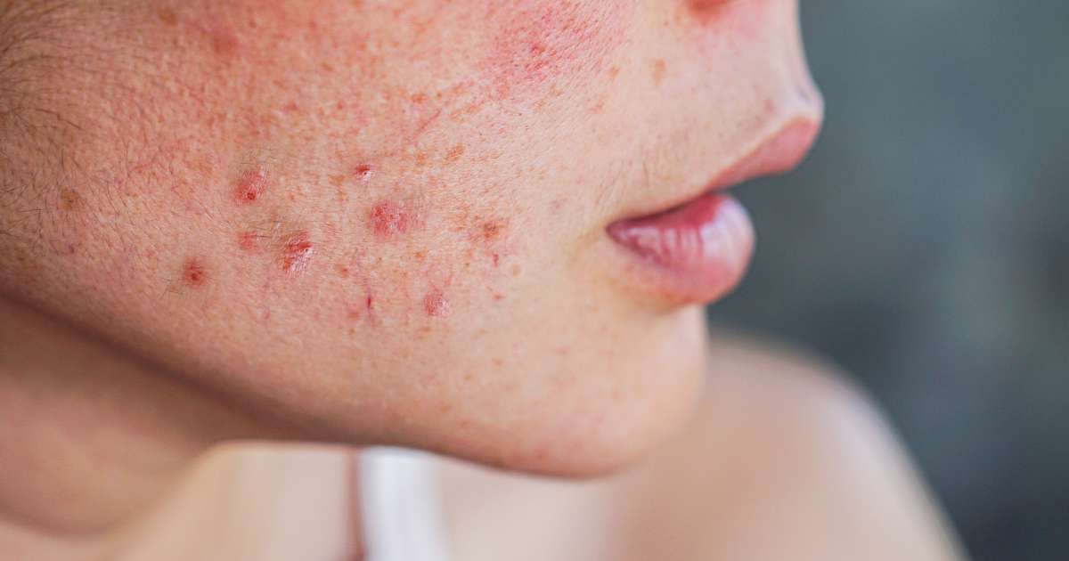 Acne Treatment in Greater Noida - Esthetica Aesthetic Clinic 2