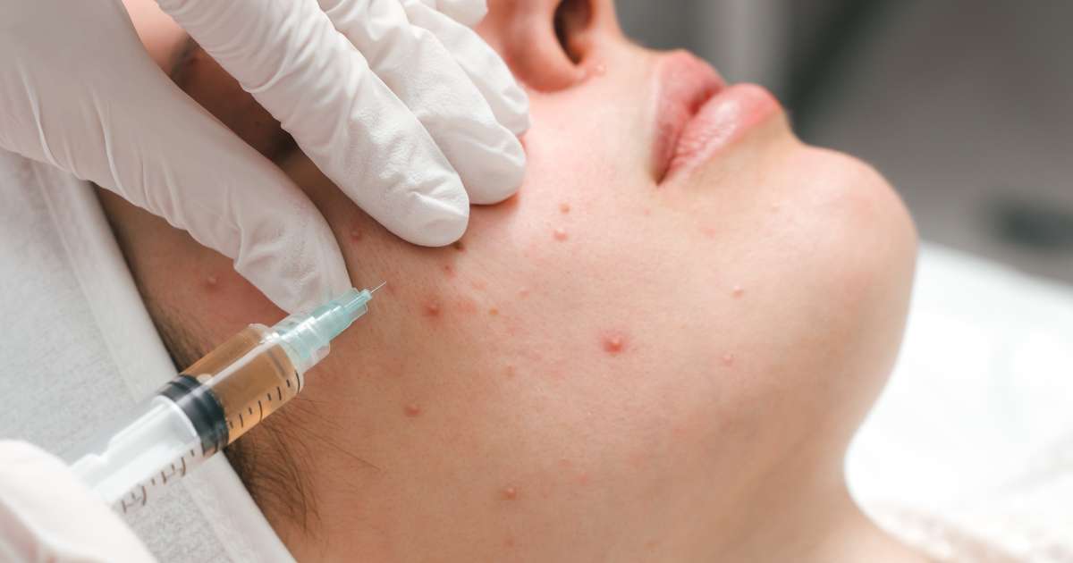 Acne Treatment Treatment in Greater Noida - Esthetica Aesthetic Clinic 3