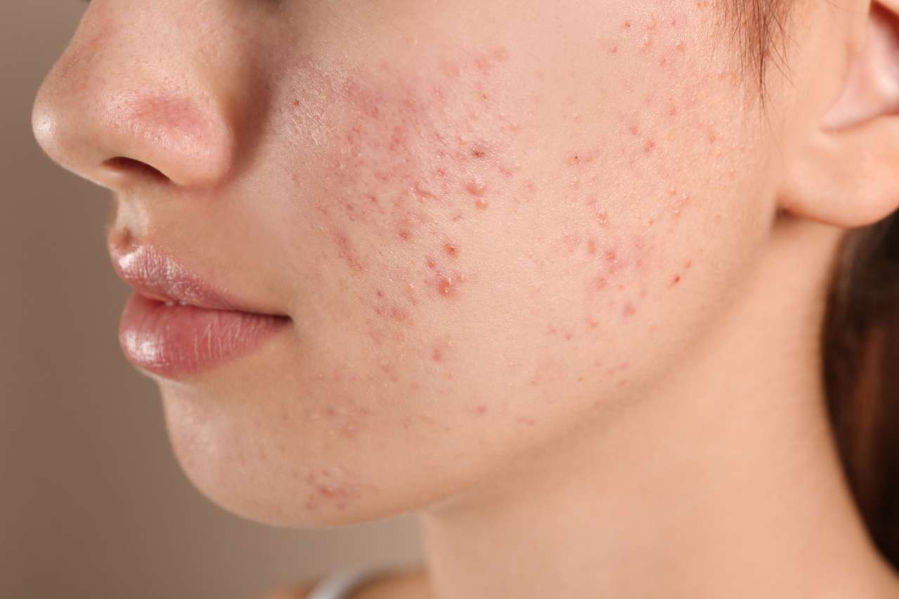 acne Treatment in Greater Noida - Esthetica Aesthetic Clinic 1