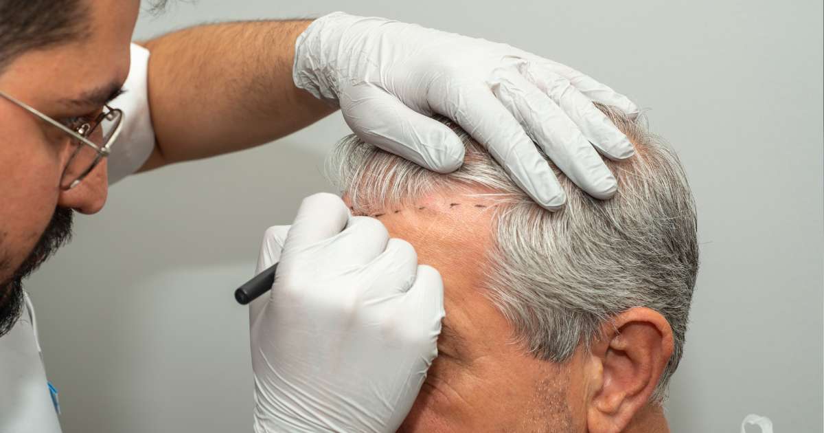 Hair Transplant Treatment in Greater Noida - Esthetica Aesthetic Clinic 3