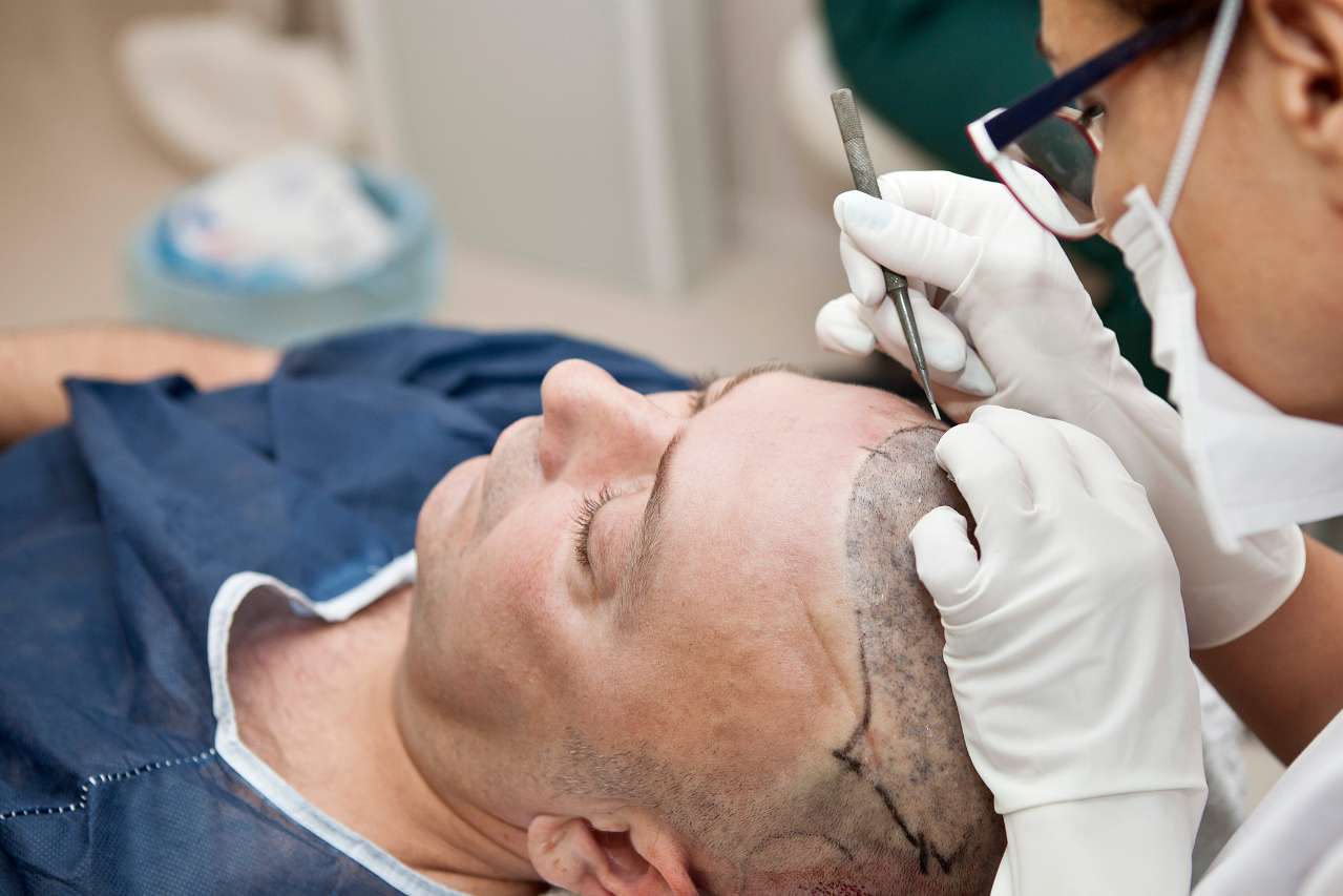 hair transplant in Greater Noida - Esthetica Aesthetic Clinic 1