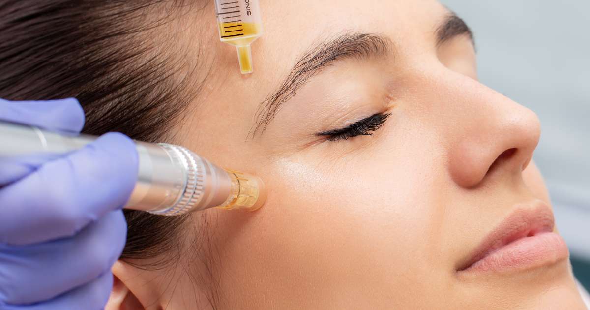 Micro Needling Treatment in Greater Noida - Esthetica Aesthetic Clinic 2