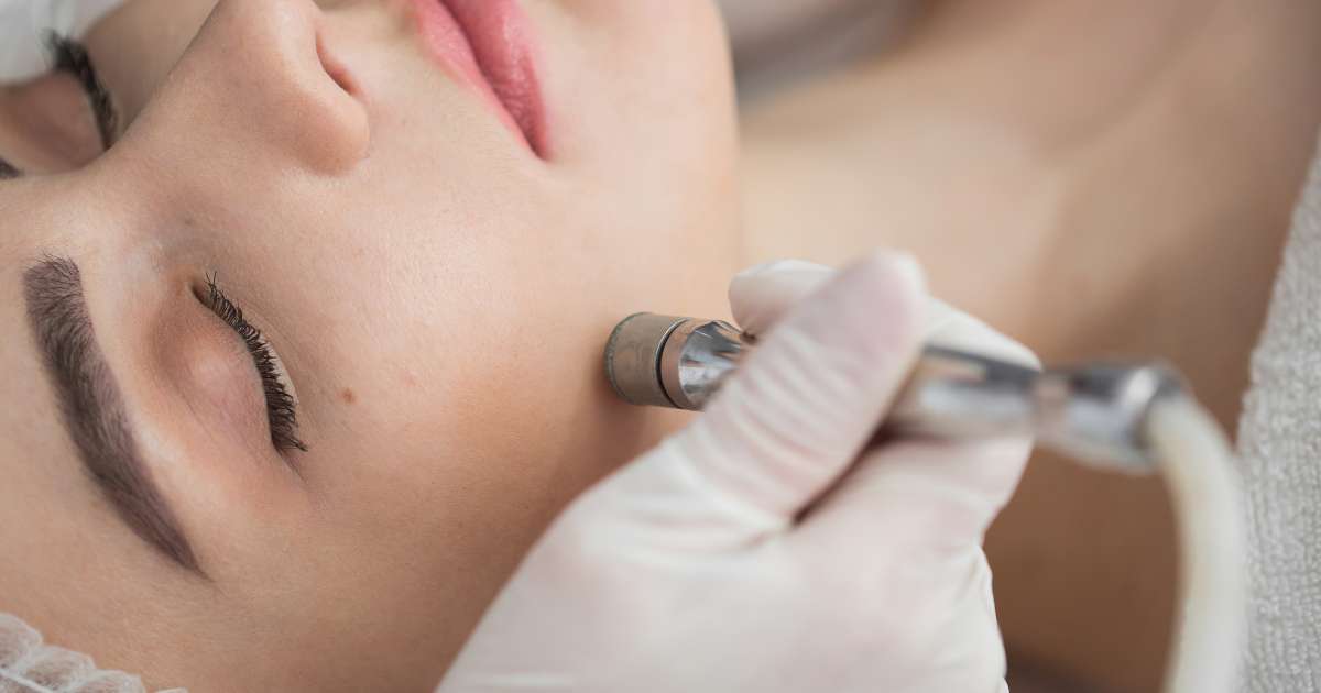 Micro Dermabrasion Treatment in Greater Noida - Esthetica Aesthetic Clinic 2