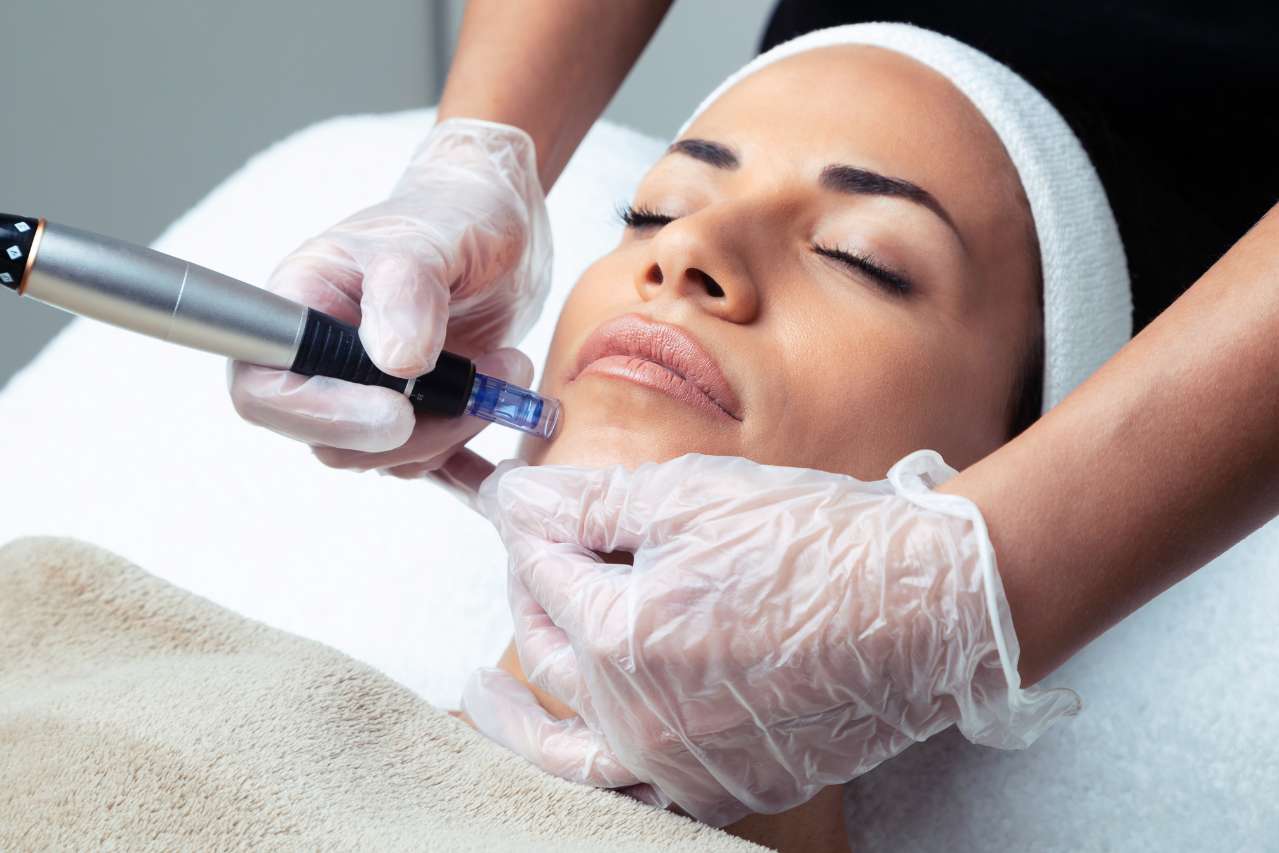 Micro needling Treatment in Greater Noida - Esthetica Aesthetic Clinic 1