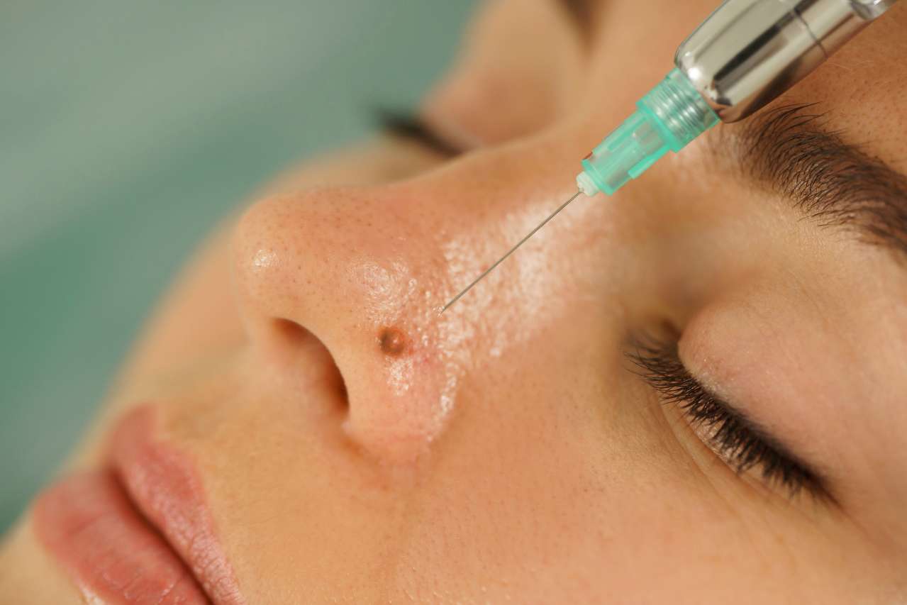 Mole & Warts Removal Treatment in Greater Noida - Esthetica Aesthetic Clinic 1