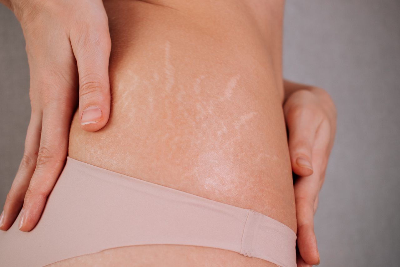 Stretch Marks Removal treatment in Greater Noida - Esthetica Esthetic Clinic 3